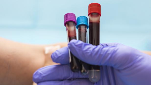 Krankenschwester hält Röhrchen mit Blutproben zur Blutgruppenbestimmung.